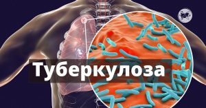 tuberoloza 2611241 Кампания „Седмица на отворените врати“ за риск от туберкулоза 09 – 13 декември 2024 г.