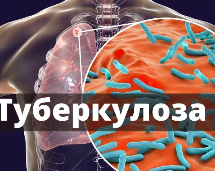 tuberoloza 2611241 Кампания „Седмица на отворените врати“ за риск от туберкулоза 09 – 13 декември 2024 г.